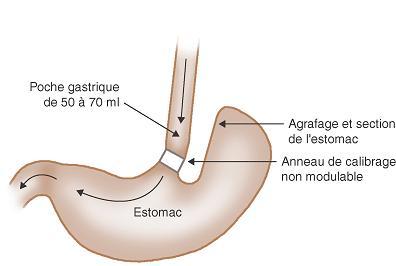 Schema d'un estomac avec gastroplastie verticale
